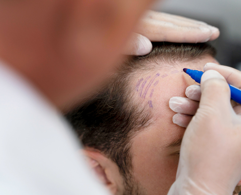Hairtransplantation bei Männern in der Praxis in Dortmund